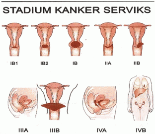 Mengenal Lebih Jauh Tentang Kanker