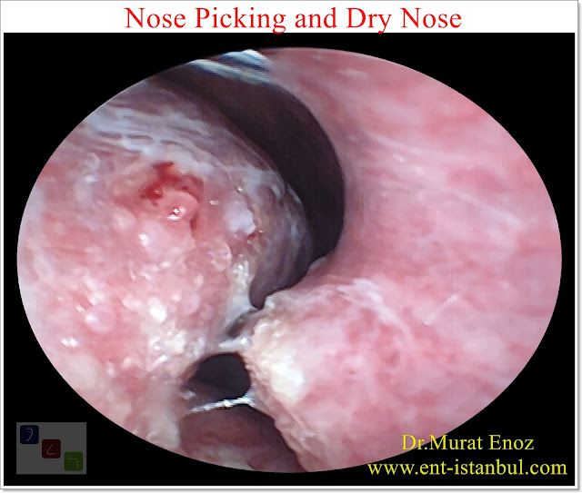 Nose Picking and Dry Nose, Nasal Dryness