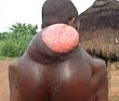 Graphic Photos: Man with massive lump on his back needs help
