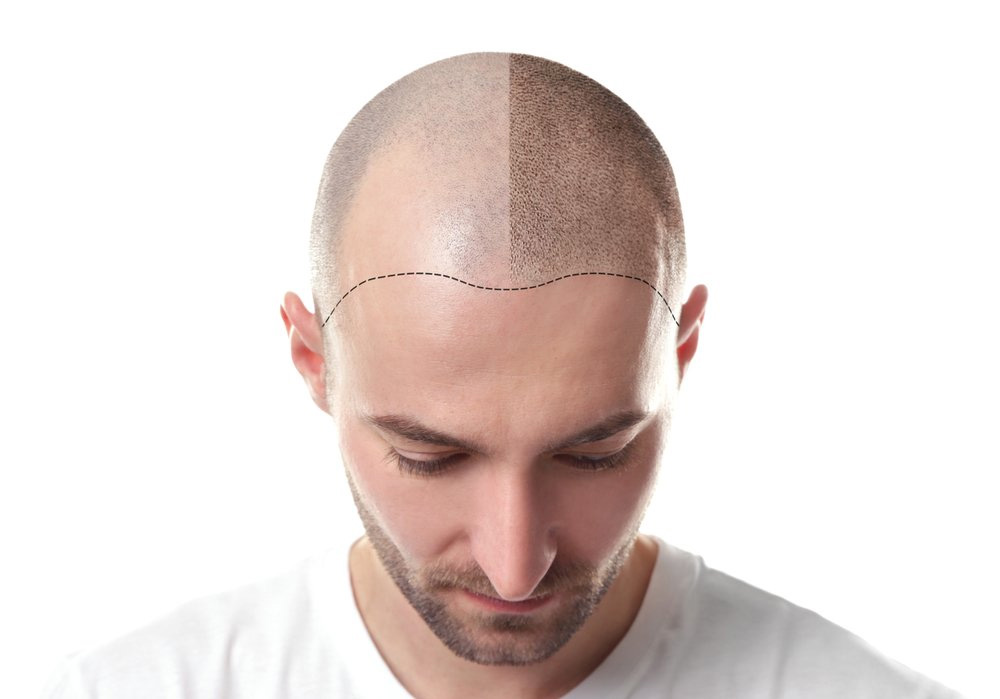 hair loss blocker funciona?