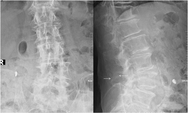 Lumbar spine X-ray, AP (left image) and lateral (right image) views illustrating close approximation and contact of spinous processes at L4-L5 level with sclerosis and flattening of the articulating surfaces (white arrow)