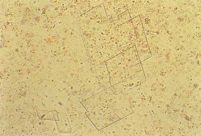 Cholesterol crystals from “kidney ﬂuid” (200x)