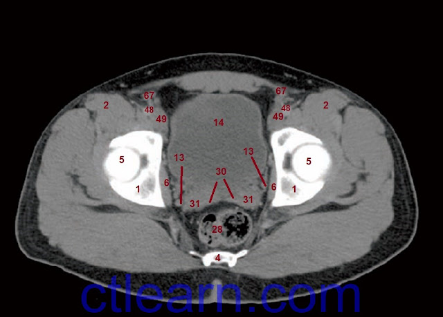 Learn CT Scan: Anatomy CT Axial Abdomen and Pelvis Male