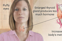 Hipertiroid - Gejala, Penyebab & Cara mengobatinya