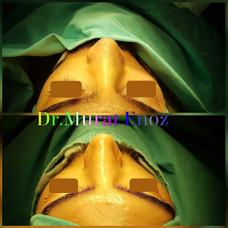 2nd Revision Rhinoplasty Operation in Men, Second Revision Nose Aesthetic Surgery For Male,Revision Rhinoplasty Istanbul,