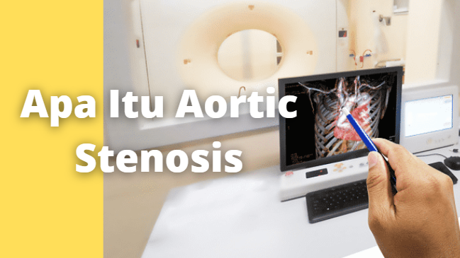 Apa Itu Aortic Stenosis : Pengertian, Tanda dan Gejala, Penyebab, Faktor Risiko Pengertian Aortic Stenosis Stenosis aorta (aortic stenosis), yang juga dikenal dengan stenosis katup aorta (aortic valve stenosis), adalah gangguan pada pembukaan katup aorta jantung yang tidak terbuka secara penuh, yang menurunkan aliran darah dari jantung.   Katup berfungsi seperti pintu, dan katup aorta merupakan salah satu dari empat katup yang mengontrol aliran darah di dalam jantung. Katup aorta normal memiliki tiga helai penutup.   Jantung mengirim darah kaya oksigen ke tubuh melalui katup ini. Pada stenosis aorta, jantung dipaksa bekerja lebih keras untuk memompa darah melalui katup dengan pembukaan yang sempit ini. Semakin lama, jantung akan menjadi bertambah besar dan melemah.  Tanda dan Gejala Aortic Stenosis Tanda-tanda dan gejala dari stenosis aorta dapat tidak terlihat di fase awal. Ketika katup menjadi lebih kecil, aliran darah akan menurun dan memicu gejala-gejala seperti : Sakit pada dada yang menyebar ke lengan dan tenggorokan Batuk, terkadang dengan darah Merasa lelah, pingsan Napas pendek disebabkan oleh kegagalan jantung sebelah kiri Masalah pernapasan selama berolahraga dapat berkembang menjadi masalah pernapasan saat beristirahat; bangun di malam hari karena tidak bisa bernapas Detak jantung cepat  Penyebab Aortic Stenosis Stenosis aorta disebabkan oleh menyempitnya katup aorta. Ada banyak faktor yang dapat menyebabkan sempitnya katup aorta. Faktor-faktor tersebut adalah : Cacat jantung bawaan: beberapa anak dilahirkan dengan katup aorta yang tidak terbentuk sempurna. Biasanya katup aorta normal memiliki tiga helai penutup. Katup aorta yang cacat kemungkinan hanya memiliki 1 helai penutup (unicuspid), 2 helai penutup (bicusbid) atau 4 helai penutup (quadricuspid). Hal ini tidak akan menimbulkan masalah hingga anak-anak tumbuh dewasa Tumpukan kalsium pada katup: Katup aorta dapat mengumpulkan deposit kalsium dari darah. Seiring bertambahnya usia, tumpukan kalsium akan menyebabkan katup aorta mengeras dan kaku, yang memicu penyempitan katup. Hal ini umum pada pria berusia lebih dari 65 tahun dan wanita berusia lebih dari 75 tahun Demam rematik: Salah satu komplikasi dari demam rematik adalah menyebabkan luka jaringan berkembang pada katup aorta. Luka jaringan ini dapat menyempitkan katup dan membuat tumpukan deposit kalsium lebih mudah. Stenosis aorta dapat terjadi di masa mendatang  Faktor Risiko Aortic Stenosis Ada banyak faktor untuk stenosis aorta, seperti: Cacatnya katup aorta: Kecacatan ini akan membuat Anda lebih berisiko dan biasanya diketahui ketika Anda lahir. Beri tahu dokter jika Anda memiliki cacat jantung bawaan Umur: Semakin bertambah usia Anda, semakin tinggi risiko Anda memiliki tumpukan kalsium pada katup aorta Pernah memiliki demam rematik: Demamrematik dapat menyebabkan katup aorta Anda mengeras, yang membuat Anda lebih berisiko terkena stenosis aorta Kondisi jantung: Para ahli menemukan bahwa ada hubungan antara penyakit ginjal kronis dan diabetes jenis 2 dengan stenosis aorta. Beritahu dokter Anda jika Anda memiliki kondisi ini Tekanan darah tinggi Kolesterol tinggi Merokok   Nah itu dia bahasan dari apa itu penyakit Aortic Stenosis. Melalui bahasan di atas bisa diketahui mengenai pengertian, tanda dan gejala, penyebab, dan faktor risiko dari Aortic Stenosis. Mungkin hanya itu yang bisa disampaikan di dalam artikel ini, mohon maaf bila terjadi kesalahan di dalam penulisan, dan terimakasih telah membaca artikel ini."God Bless and Protect Us"