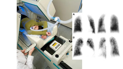 What Is Lung Ventilation-Perfusion Scan