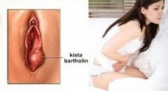 Obat Kista Bartholin