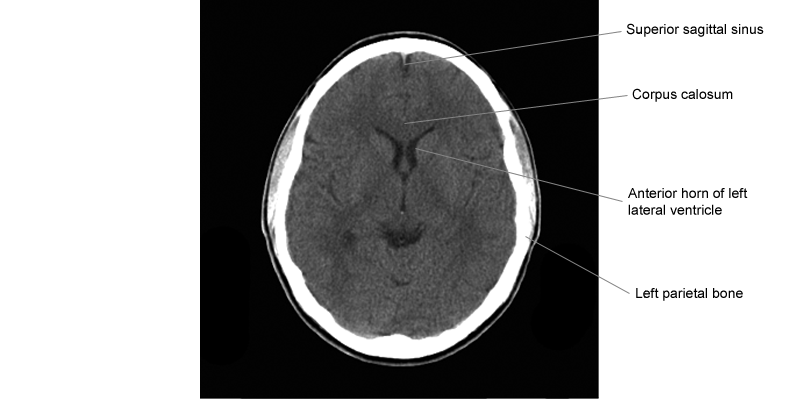 Cafe Radiologi: Anatomi dari gambaran CT Scan Kepala