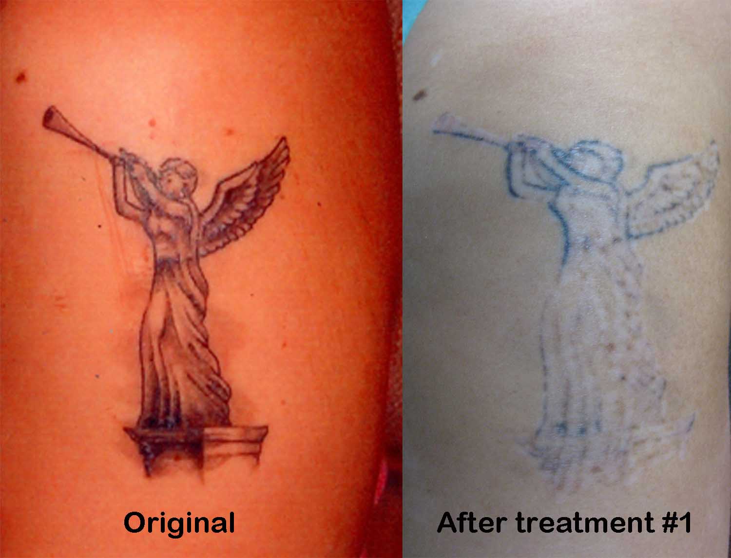 Laser Removal Tattoo