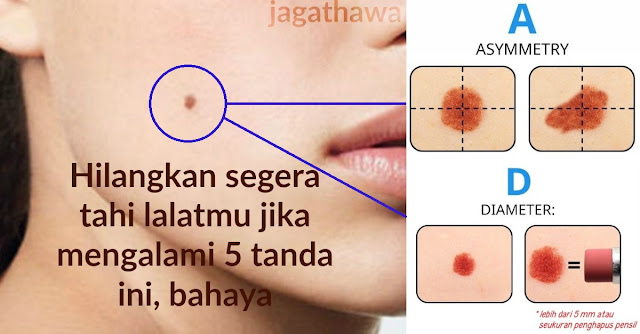 Bahaya !! Jika Kamu Mengalami 5 Tanda ini Pada Tahi Lalatmu, Segera Hilangkan !!