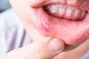 10 How To Cure Canker Sores Quickly And Naturally