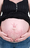 Oil for Pregnancy Stretch Marks