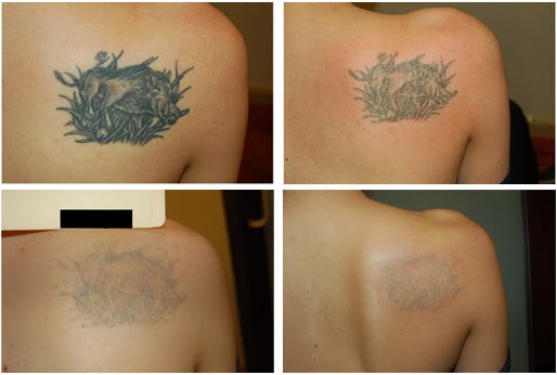 Tattoo Removal is safe when done by qualified &amp;efficient doctors like ...