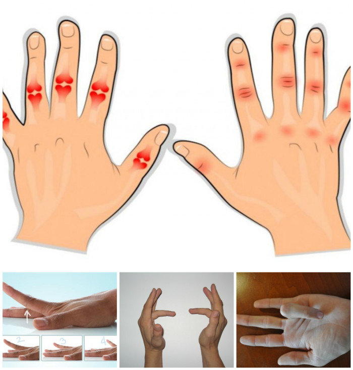 12 Simple Exercises And Home Remedies To Relieve Arthritis