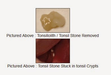 Tonsil Stones Picture