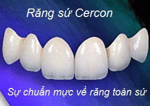 Chi phí bọc răng sứ Cercon là bao nhiêu?