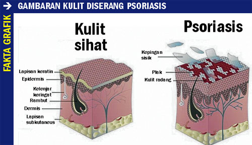 Penyakit kulit psoriasis - Sel kulit mati tidak sekata