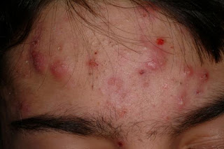 Comment traiter l'acné kyste