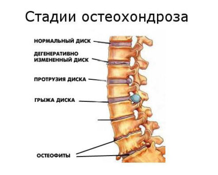 Остеохондроз лечение в Одессе