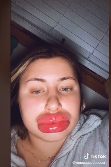 Woman Lips Swells after undergoing Lip Fillers (Photos)