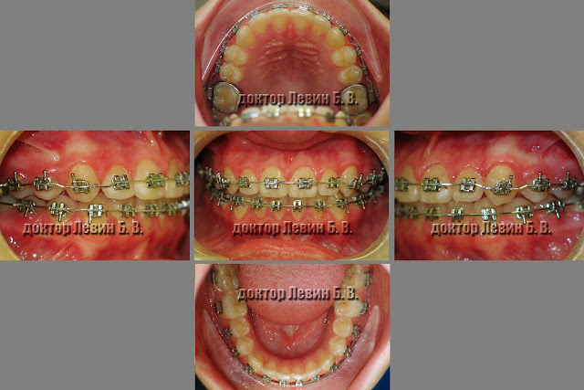 Три фото зубов характеризующие прикус пациента на 18 месяце лечения