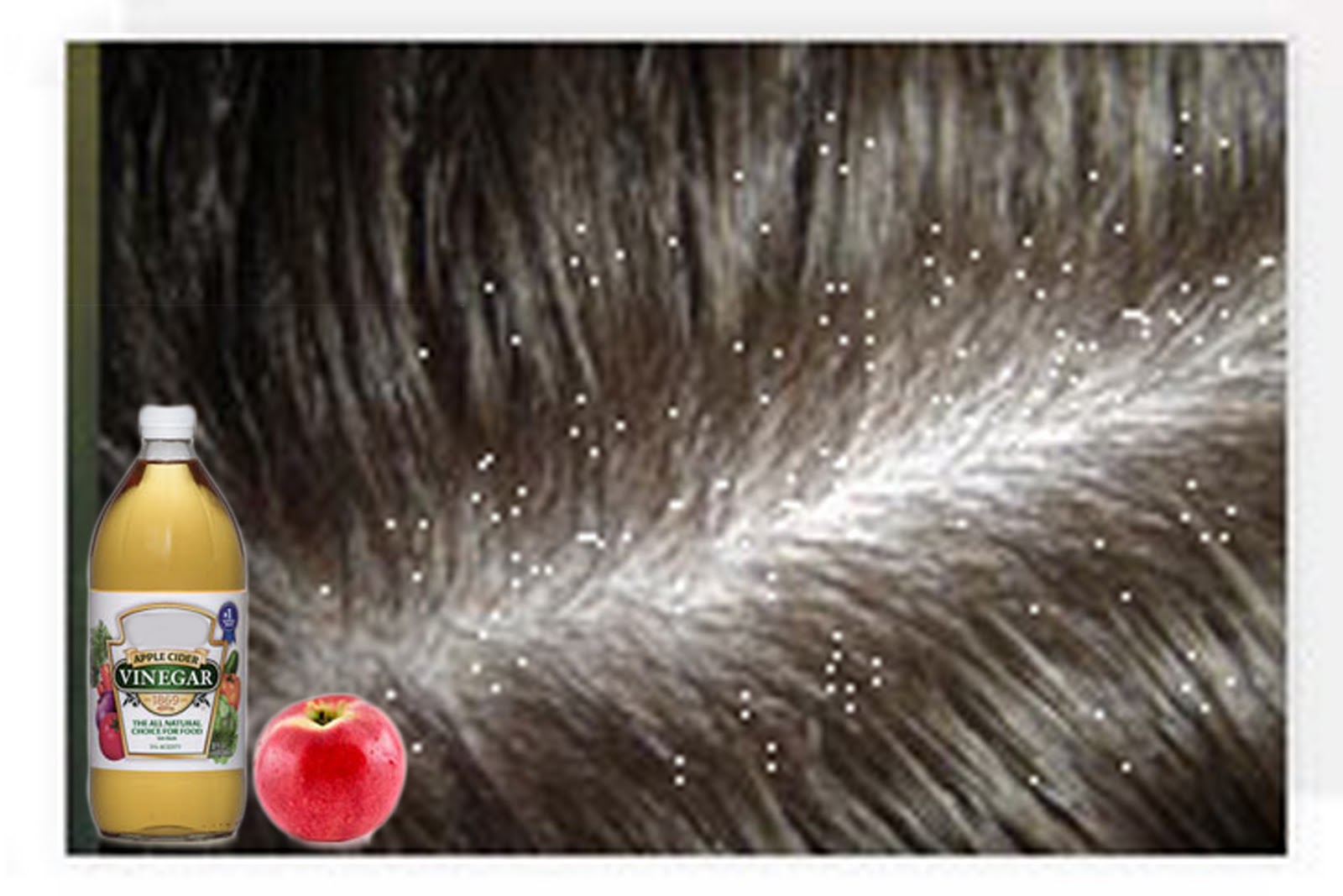 Scalp Diseases on Dandruff Problem Then Use Apple Cider Vinegar   Overcoming Diseases