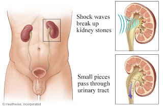 cara menghancurkan batu ginjal tanpa operasi,obat batu ginjal,obat kencing batu,cara mengeluarkan batu ginjal tanpa operasi,cara menghilangkan batu ginjal tanpa operasi