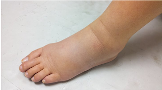 Swollen lower legs and feet are regular indications of edema.Amawasri Pakdara