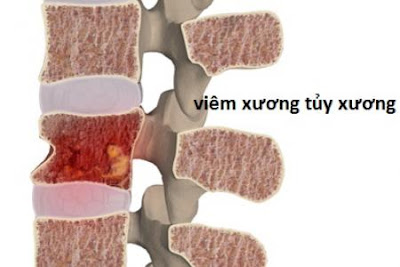 Tìm hiểu bệnh viêm xương tủy xương