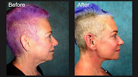 Rhytidectomy - Neck Lift Procedures