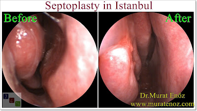 Septoplasty in Istanbul - The Nasal Septum - Deviated Septum - Septoplasty Definition - Symptoms of Deviated Septum - Septoplasty Price Istanbul - Septoplasty in Turkey - How Much Does Deviated Septum Repair? - Caudal Septoplasty - Septoplasty in Turkey - Septoplasty Turkey - Cost of Septoplasty - Symptoms of Nasal Septum Deviation - Septoplasty Operation - Diagnosis of Deviated Nasal Septum - Diagnosis of Deviated Septum - Differential Diagnosis of Deviated Nasal Septum - Nasal septal deviation - NSD - Types of deviated septum - Normal nasal septum - "C"- shaped deviation of the septum - "S"- shaped deviation of the septum - Dislocation of septal cartilage - Subluxation of septal cartilage - Dislocation of the caudal septum - Caudal septum deviation - Septal spur - Thickening of the nasal septum - Septum deviasyonu türleri - Nasal septal spur - Bone spur formation of the septum - Anterior dislocation of septum - Caudal dislocation of septum - How Much Does a Septoplasty Cost in Istanbul? - Septoplasty Operation Technique - Surgcal Technique of Septoplasty Operation - Nasal Splint Removal Video - Silicone Nasal Splints Advantages - Post-Operative Instruction For Septoplasty - Risks And Complications Of Septoplasty - Risks And Complications Of Deviated Septum Surgery - Nasal Septal Perforation - Nasal Septum Perforation - Nasal Septum Perforation Symptoms - Nasal Septum Perforation Diagnosis - Nasal Septum Perforation Treatment - Nasal Septum Perforation Closure - Nasal Surgical Repair Of Nasal Septum Perforation - Nasal Adhesion (Synechia) - Nasal Tip Ptosis - Saddle Nose Deformity - Saddle Nose Correction - Positive Health Effects Of Deviated Nasal Septum Surgery - Positive Health Effects Of Septoplasty Surgery - Functions of The Nose - Contact Point Headaches