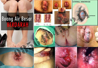 Obat Benjolan (Wasir) Di Anus Selain Faktu