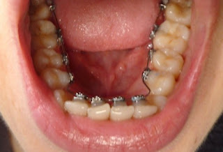 Les contre-indications de l’orthodontie linguale