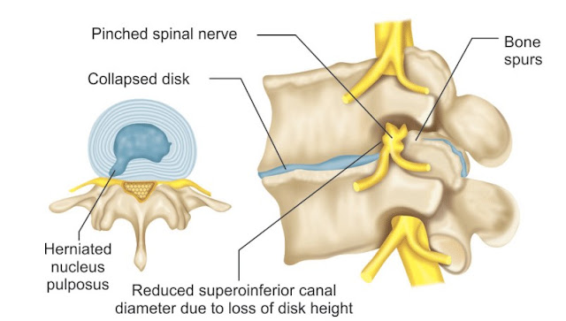 CAUSES OF LUMBAR CANAL STENOSIS