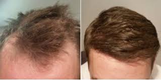 hair transplant in Islamabad