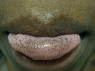 Hyperpigmentation of the tongue causes