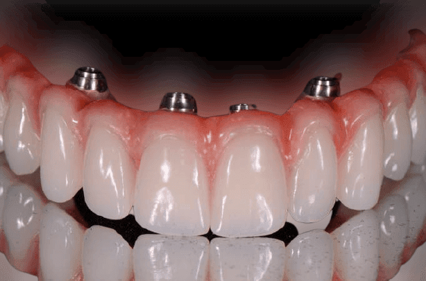 This is what a full mouth dental implant will cost in 2021
