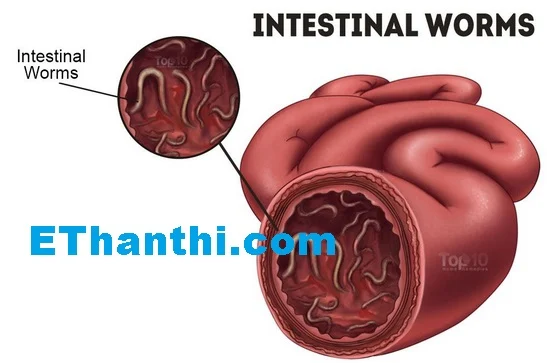 குடலில் உள்ள புழுக்களை அழிக்கும் வைத்தியங்கள் !