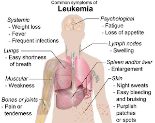 penyebab dan gejala penyakit leukimia