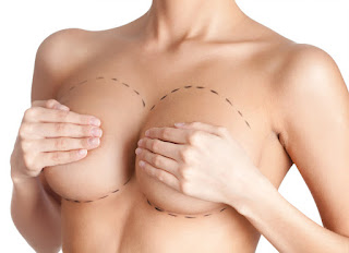 Chi phí nâng ngực không cần phẫu thuật là bao nhiêu?