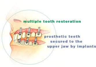 Multiple Tooth Implants