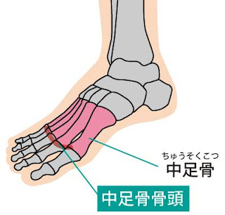 中足骨骨頭部の解説イラスト。中足骨骨頭部は足の付け根にある骨の先端部のことです。