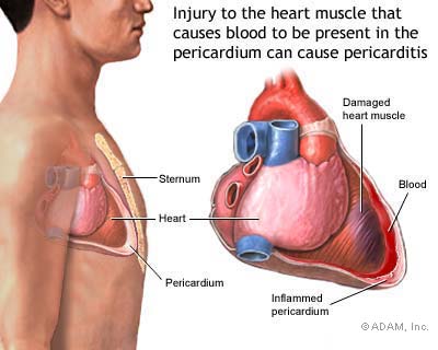 women heart attack pain. of mild heart attack is