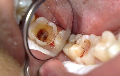 Nguyên nhân răng sâu bị chảy máu