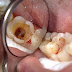 Điều trị răng sâu bị chảy máu