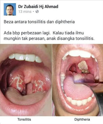 Beza Tonsil dan Difteria