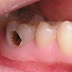 Bọc răng sứ cho răng sâu có lợi ích gì?