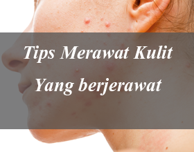 Tips merawat kulit yang berjerawat