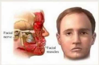 Cara Mengatasi Stroke Ringan Pada Wajah